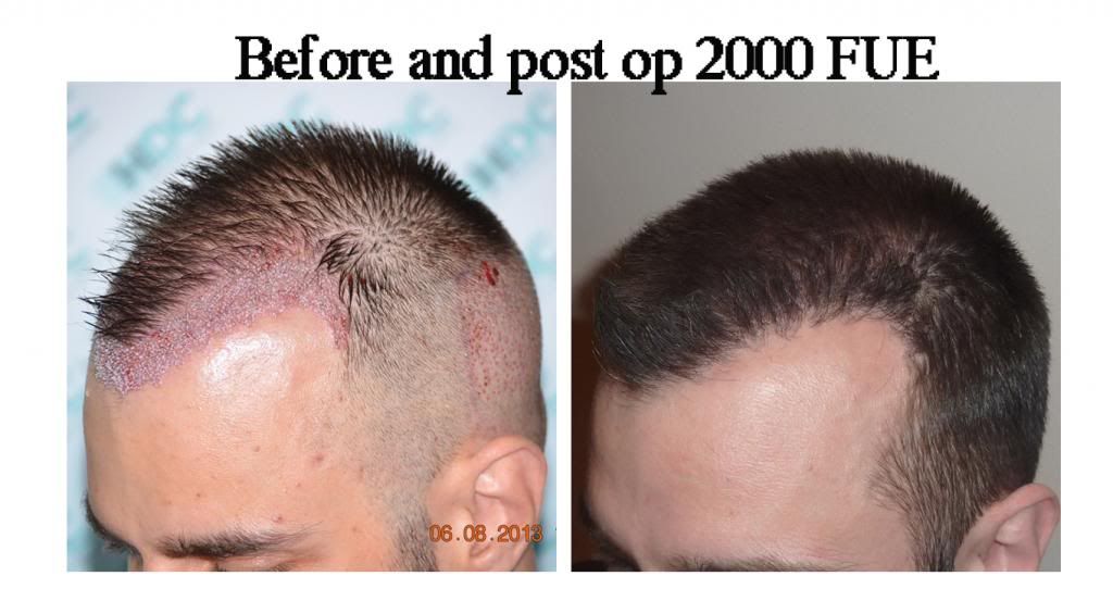 HDC Hair Transplant Clinic - FUE 2000 Grafts - Hairline - Results ...